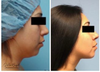 chin liposuction brisbane