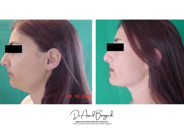 double chin liposuction 123
