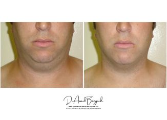 double chin treatment 000