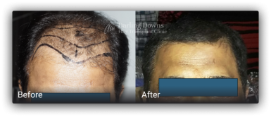 fue hair replacement 29438