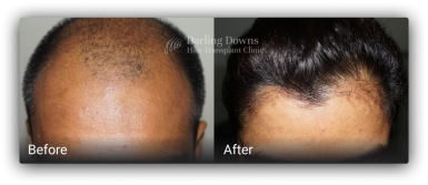 fue hair transplant brisbane 1111