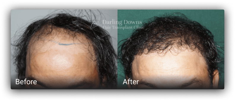 fue hair replacement