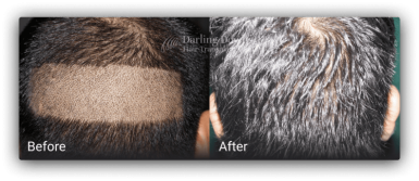 fue hair transplant brisbane