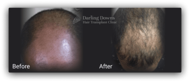 hair transplant brisbane