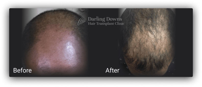 hair transplant brisbane