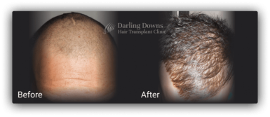 fue hair transplant clinic brisbane