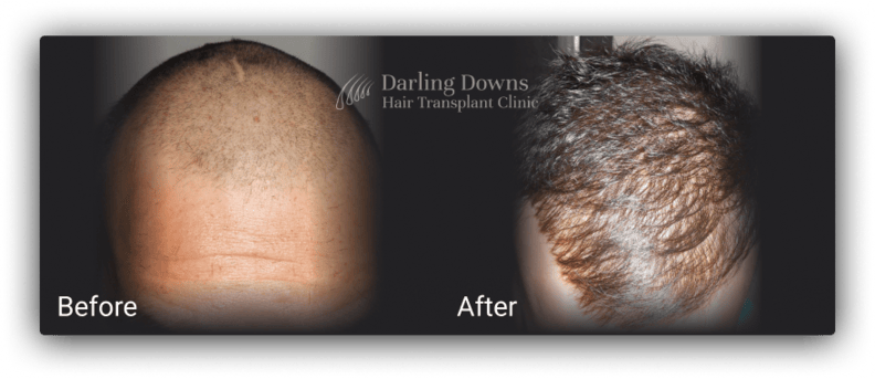 fue hair transplant clinic brisbane