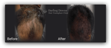 hair transplantation fue
