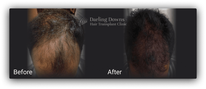 hair transplantation fue