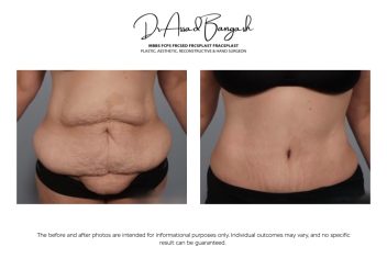 abdominoplasty brisbane cutis 11
