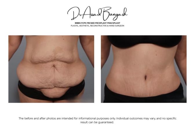 abdominoplasty brisbane cutis 11