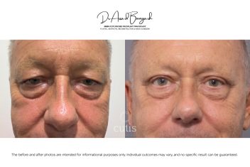 blepharoplasty eyelid surgery brisbane