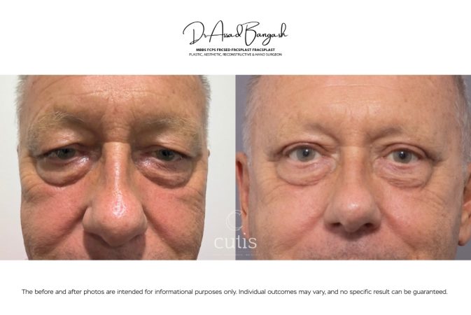 blepharoplasty eyelid surgery brisbane