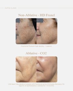 laser resurfacing
