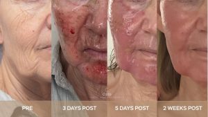 ablative co2 laser healing