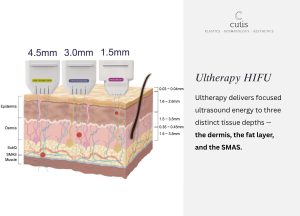 ultherapy vs xerf ultherapy vs xerf