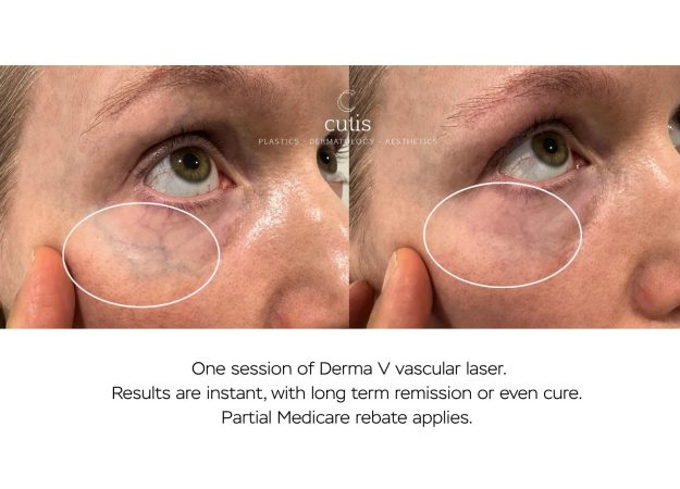 Periorbital vein treatment