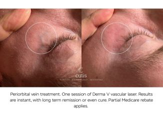 periorbital vein under eye treatment