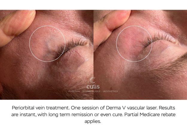 periorbital vein under eye treatment