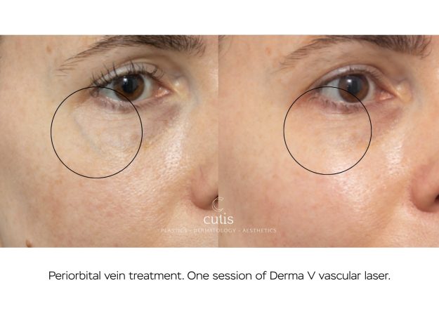 periorbital vein under eye treatment