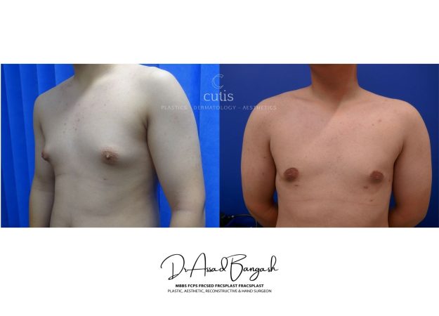 gynecomastia surgery brisbane