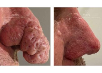 rhinophyma removal